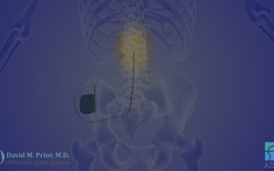 Relief Through Innovation: Spinal Cord Stimulator Implants by Dr. David Prior, Arizona’s Premier Orthopedic Spine Surgeon